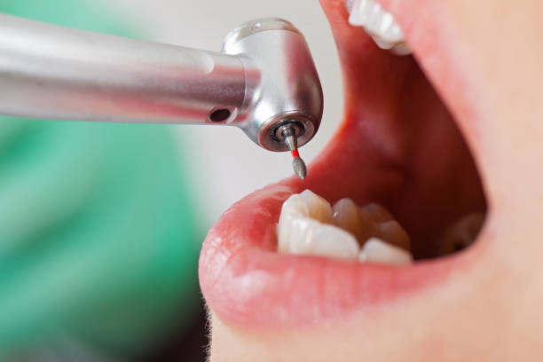 Best Emergency Tooth Extraction in Los Alamitos, CA